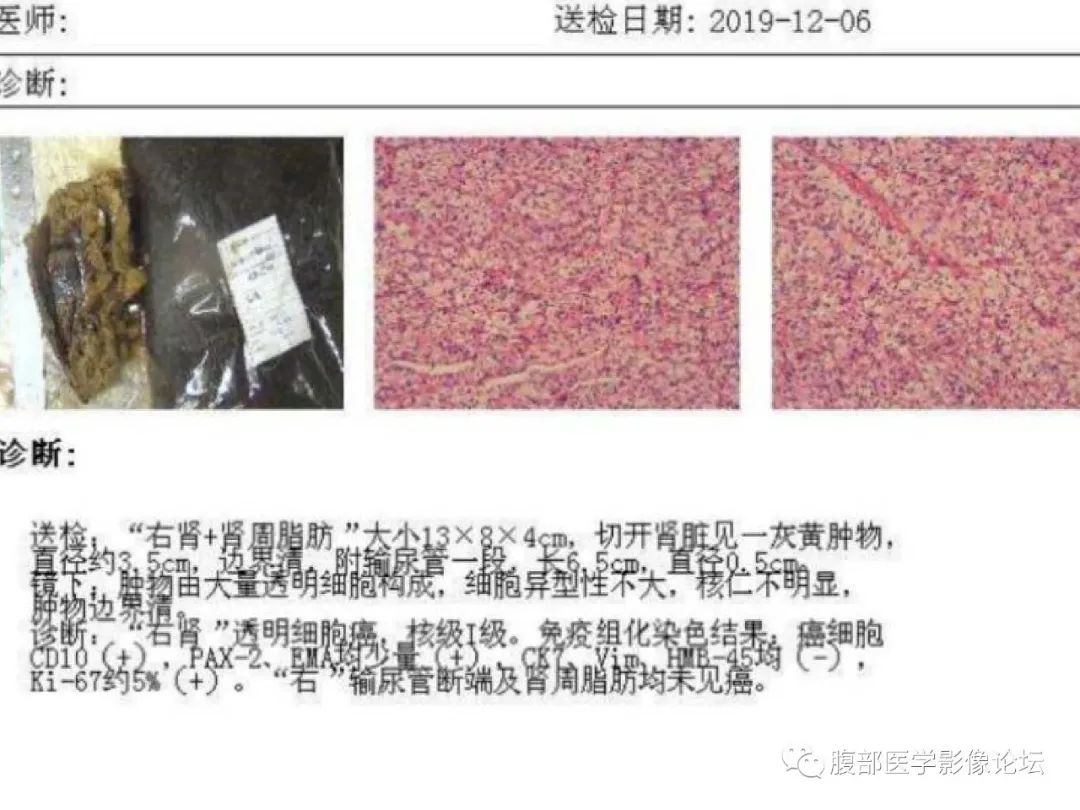 影像PPT - 【病例】肾脏透明细胞癌1例CT影像-13