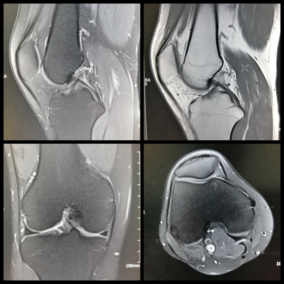 影像PPT - 膝关节半月板病变的 MRI 诊断与鉴别-2 影像PPT - 膝关节半月板病变的 MRI 诊断与鉴别-2
