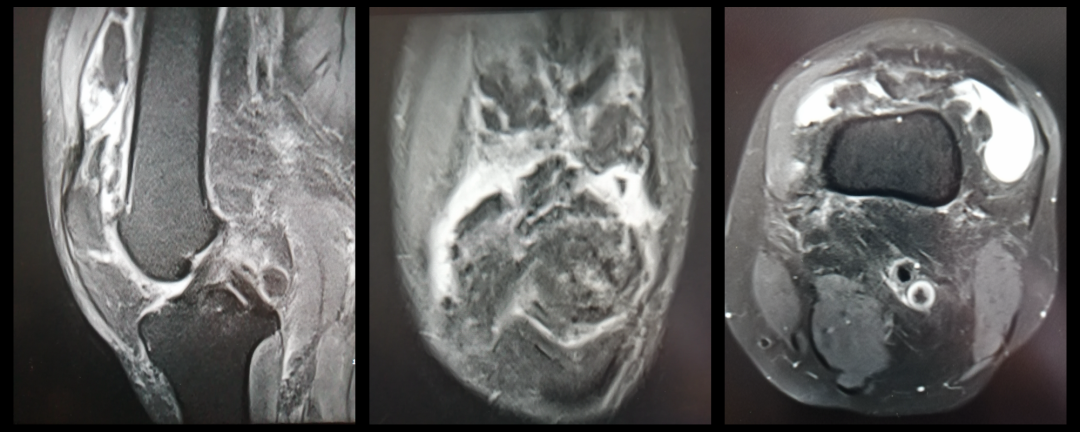 影像PPT - 膝关节半月板病变的 MRI 诊断与鉴别-6 影像PPT - 膝关节半月板病变的 MRI 诊断与鉴别-6