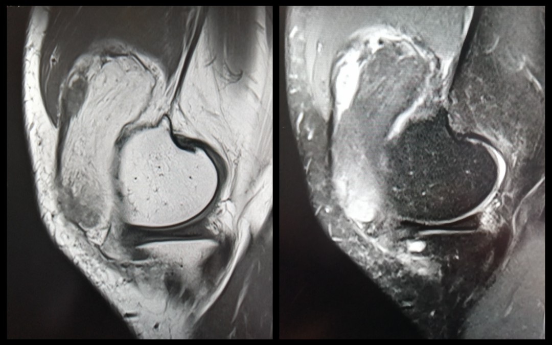 影像PPT - 膝关节半月板病变的 MRI 诊断与鉴别-4 影像PPT - 膝关节半月板病变的 MRI 诊断与鉴别-4