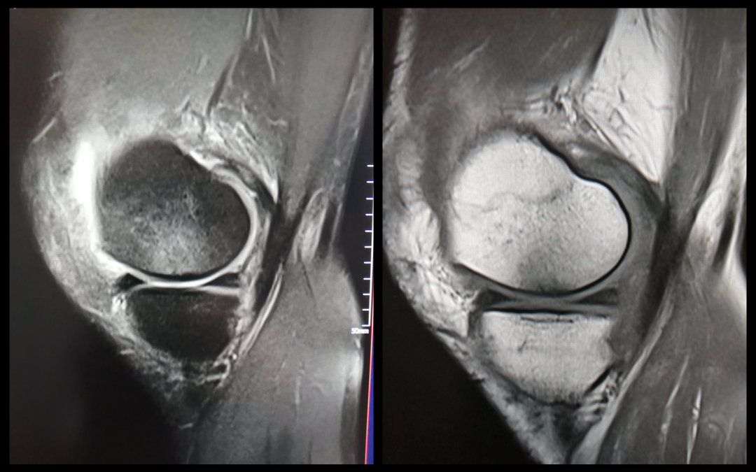影像PPT - 膝关节半月板病变的 MRI 诊断与鉴别-5 影像PPT - 膝关节半月板病变的 MRI 诊断与鉴别-5