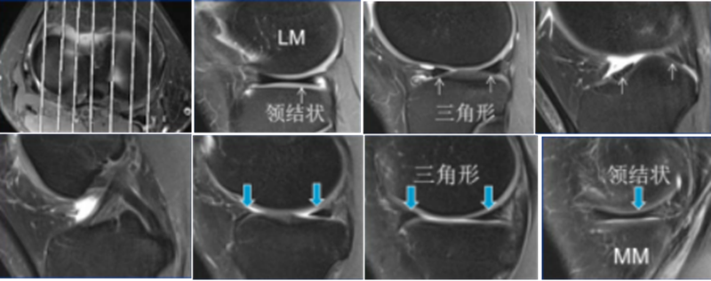影像PPT - 膝关节半月板病变的 MRI 诊断与鉴别-8 影像PPT - 膝关节半月板病变的 MRI 诊断与鉴别-8