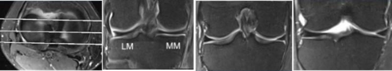 影像PPT - 膝关节半月板病变的 MRI 诊断与鉴别-9 影像PPT - 膝关节半月板病变的 MRI 诊断与鉴别-9
