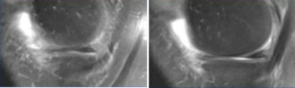 影像PPT - 膝关节半月板病变的 MRI 诊断与鉴别-12 影像PPT - 膝关节半月板病变的 MRI 诊断与鉴别-12