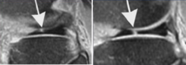 影像PPT - 膝关节半月板病变的 MRI 诊断与鉴别-11 影像PPT - 膝关节半月板病变的 MRI 诊断与鉴别-11
