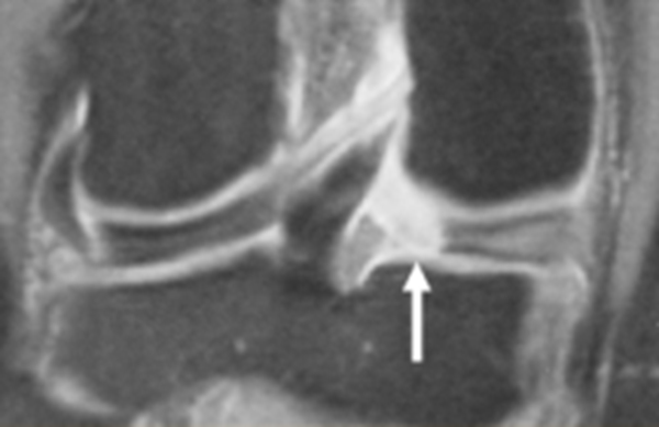 影像PPT - 膝关节半月板病变的 MRI 诊断与鉴别-13 影像PPT - 膝关节半月板病变的 MRI 诊断与鉴别-13