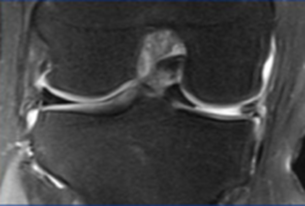 影像PPT - 膝关节半月板病变的 MRI 诊断与鉴别-16 影像PPT - 膝关节半月板病变的 MRI 诊断与鉴别-16