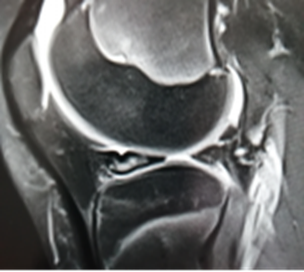 影像PPT - 膝关节半月板病变的 MRI 诊断与鉴别-15 影像PPT - 膝关节半月板病变的 MRI 诊断与鉴别-15