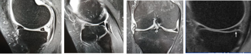 影像PPT - 膝关节半月板病变的 MRI 诊断与鉴别-14 影像PPT - 膝关节半月板病变的 MRI 诊断与鉴别-14