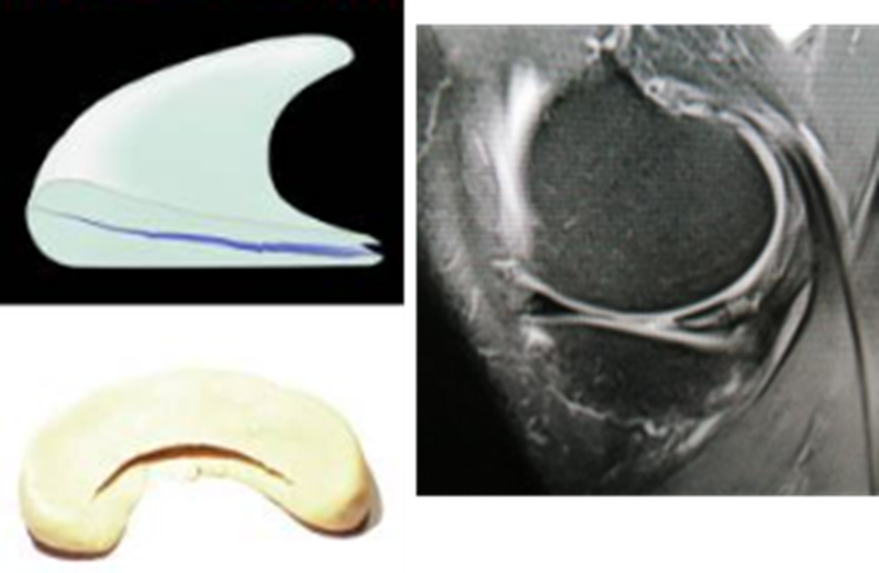影像PPT - 膝关节半月板病变的 MRI 诊断与鉴别-18 影像PPT - 膝关节半月板病变的 MRI 诊断与鉴别-18
