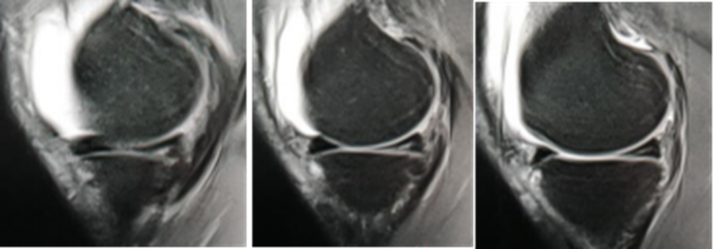 影像PPT - 膝关节半月板病变的 MRI 诊断与鉴别-19 影像PPT - 膝关节半月板病变的 MRI 诊断与鉴别-19