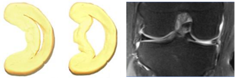 影像PPT - 膝关节半月板病变的 MRI 诊断与鉴别-20 影像PPT - 膝关节半月板病变的 MRI 诊断与鉴别-20