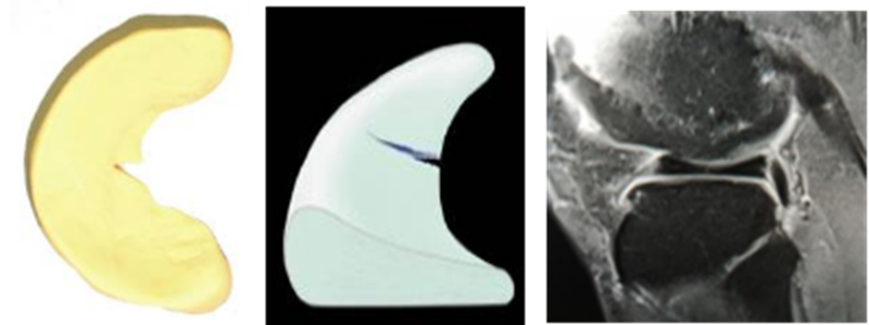 影像PPT - 膝关节半月板病变的 MRI 诊断与鉴别-21 影像PPT - 膝关节半月板病变的 MRI 诊断与鉴别-21