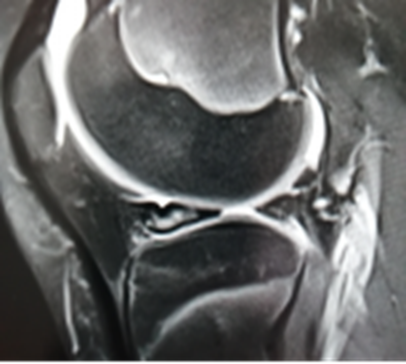 影像PPT - 膝关节半月板病变的 MRI 诊断与鉴别-22 影像PPT - 膝关节半月板病变的 MRI 诊断与鉴别-22