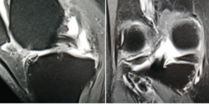 影像PPT - 膝关节半月板病变的 MRI 诊断与鉴别-23 影像PPT - 膝关节半月板病变的 MRI 诊断与鉴别-23
