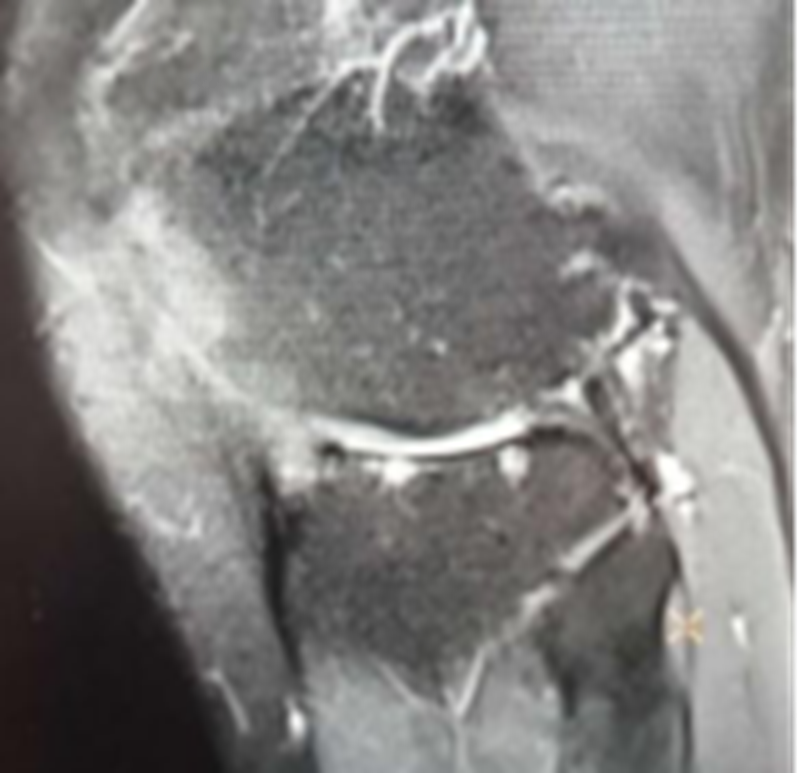 影像PPT - 膝关节半月板病变的 MRI 诊断与鉴别-24 影像PPT - 膝关节半月板病变的 MRI 诊断与鉴别-24