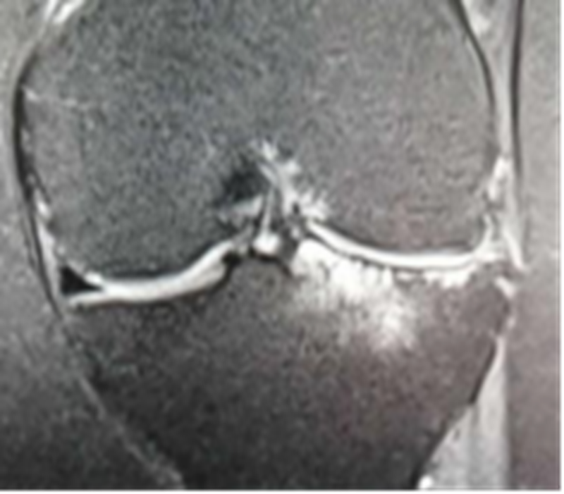 影像PPT - 膝关节半月板病变的 MRI 诊断与鉴别-25 影像PPT - 膝关节半月板病变的 MRI 诊断与鉴别-25