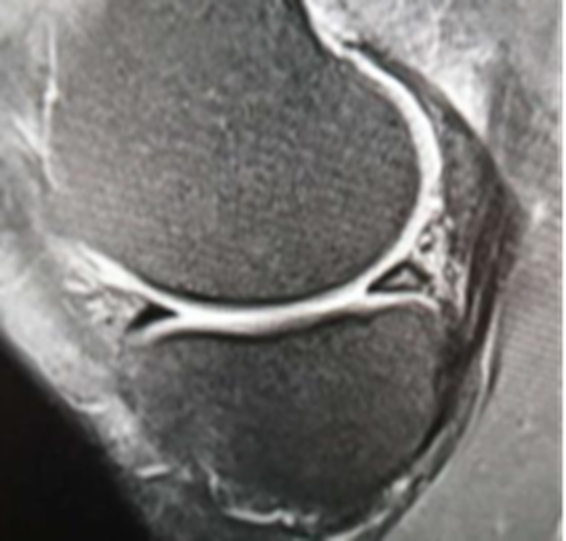 影像PPT - 膝关节半月板病变的 MRI 诊断与鉴别-27 影像PPT - 膝关节半月板病变的 MRI 诊断与鉴别-27