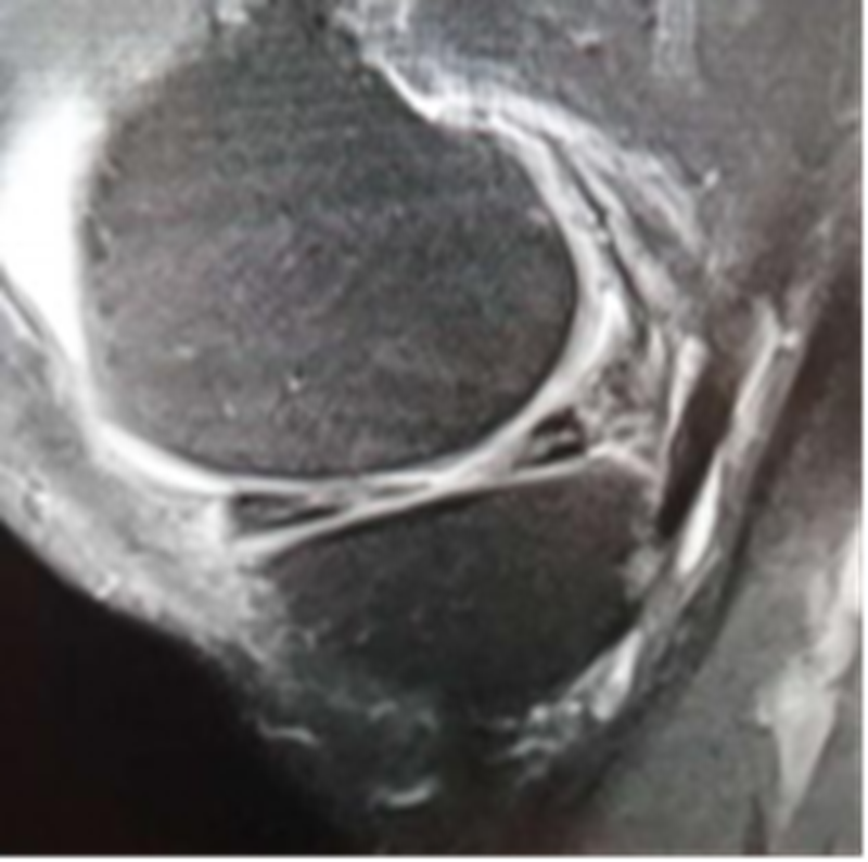 影像PPT - 膝关节半月板病变的 MRI 诊断与鉴别-26 影像PPT - 膝关节半月板病变的 MRI 诊断与鉴别-26