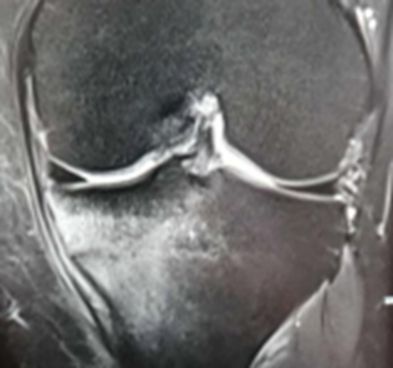 影像PPT - 膝关节半月板病变的 MRI 诊断与鉴别-28 影像PPT - 膝关节半月板病变的 MRI 诊断与鉴别-28