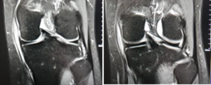 影像PPT - 膝关节半月板病变的 MRI 诊断与鉴别-31 影像PPT - 膝关节半月板病变的 MRI 诊断与鉴别-31