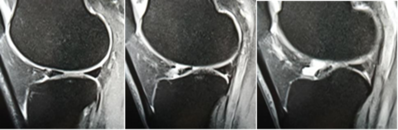 影像PPT - 膝关节半月板病变的 MRI 诊断与鉴别-32 影像PPT - 膝关节半月板病变的 MRI 诊断与鉴别-32