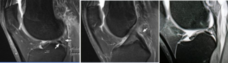 影像PPT - 膝关节半月板病变的 MRI 诊断与鉴别-30 影像PPT - 膝关节半月板病变的 MRI 诊断与鉴别-30