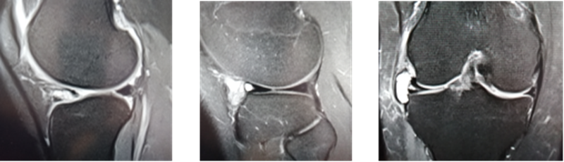 影像PPT - 膝关节半月板病变的 MRI 诊断与鉴别-34 影像PPT - 膝关节半月板病变的 MRI 诊断与鉴别-34