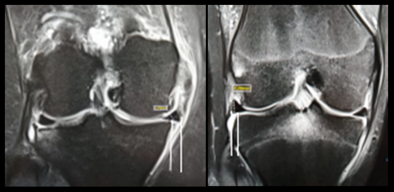 影像PPT - 膝关节半月板病变的 MRI 诊断与鉴别-33 影像PPT - 膝关节半月板病变的 MRI 诊断与鉴别-33
