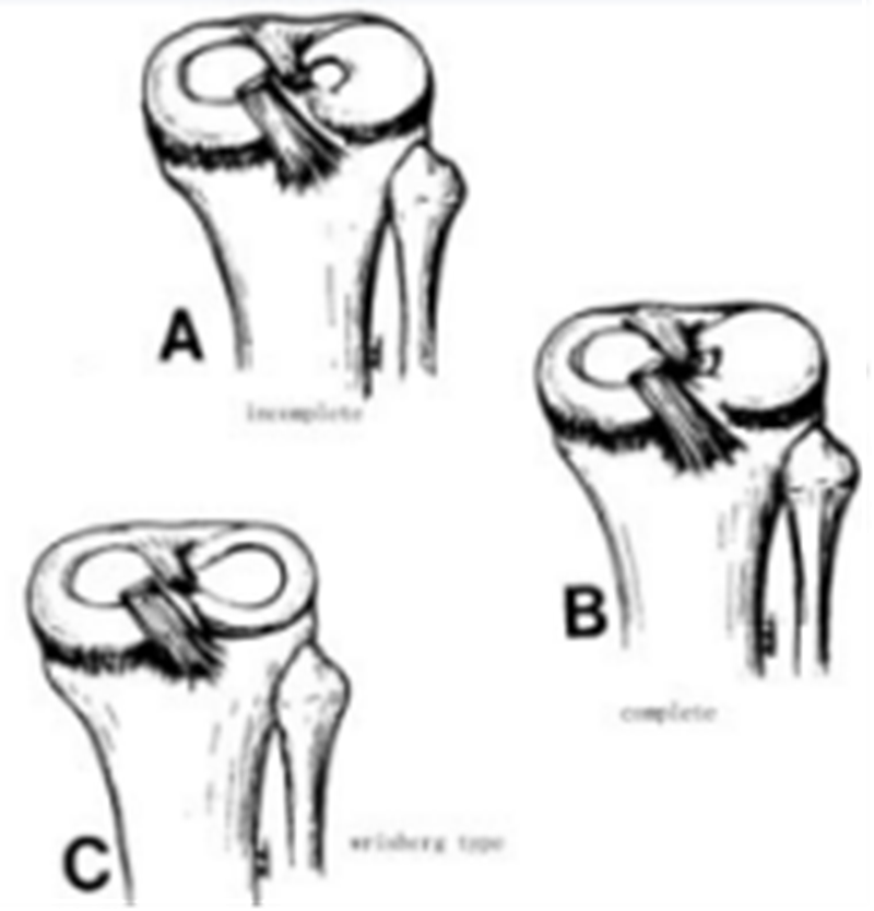 影像PPT - 膝关节半月板病变的 MRI 诊断与鉴别-35 影像PPT - 膝关节半月板病变的 MRI 诊断与鉴别-35