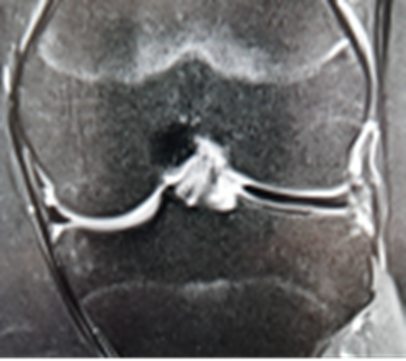 影像PPT - 膝关节半月板病变的 MRI 诊断与鉴别-36 影像PPT - 膝关节半月板病变的 MRI 诊断与鉴别-36