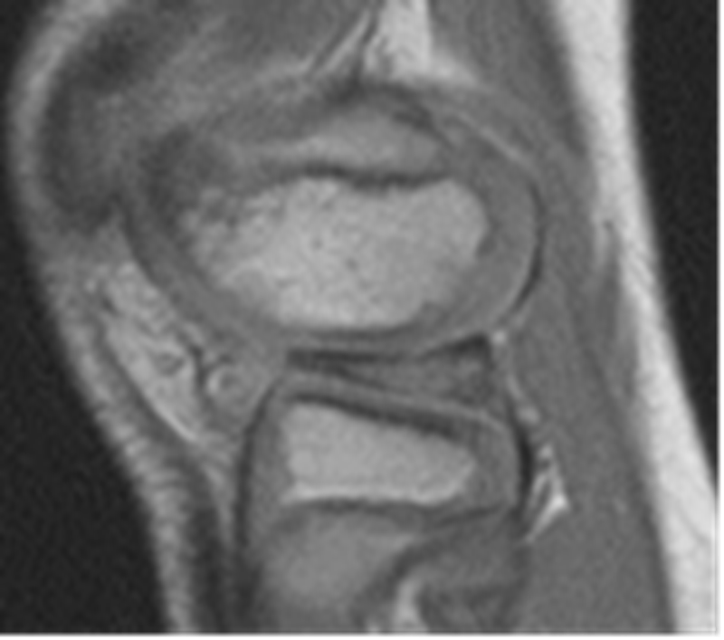 影像PPT - 膝关节半月板病变的 MRI 诊断与鉴别-38 影像PPT - 膝关节半月板病变的 MRI 诊断与鉴别-38