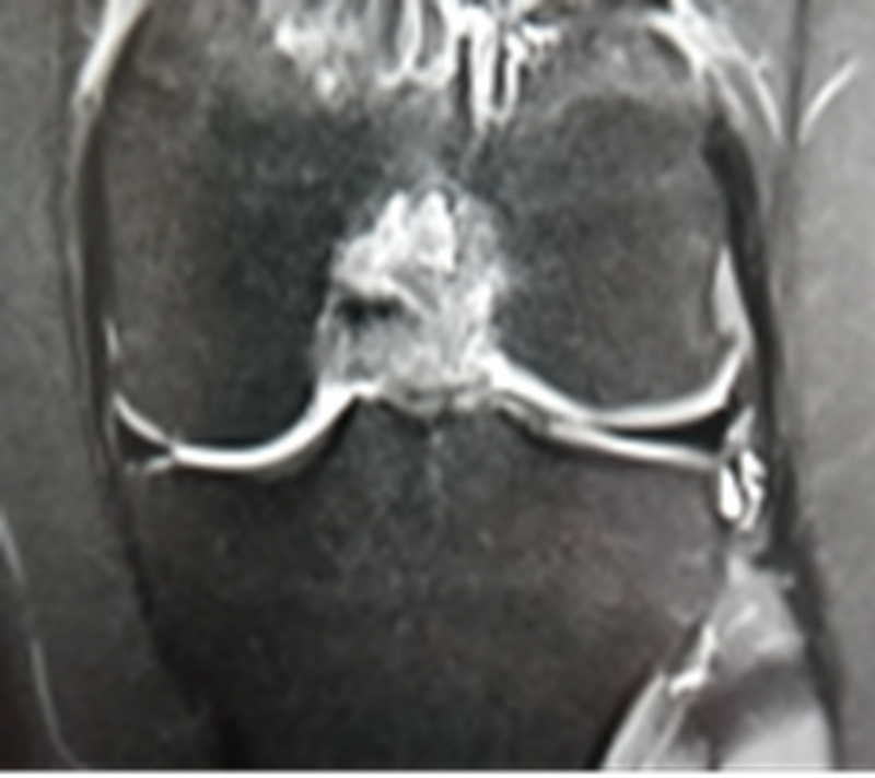 影像PPT - 膝关节半月板病变的 MRI 诊断与鉴别-37 影像PPT - 膝关节半月板病变的 MRI 诊断与鉴别-37