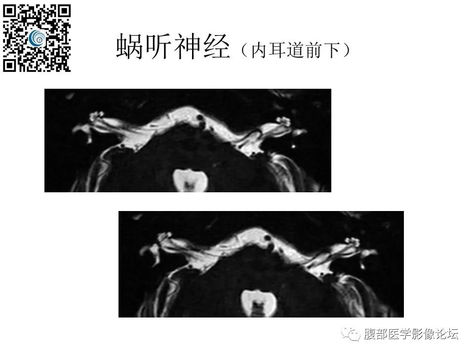 影像PPT - 【PPT】颅骨颅底系列之触底四神共一门-12