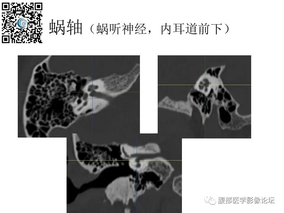 影像PPT - 【PPT】颅骨颅底系列之触底四神共一门-11