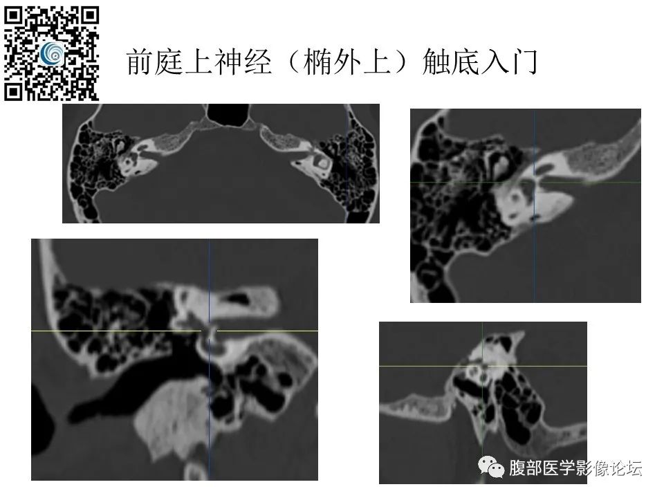 影像PPT - 【PPT】颅骨颅底系列之触底四神共一门-15