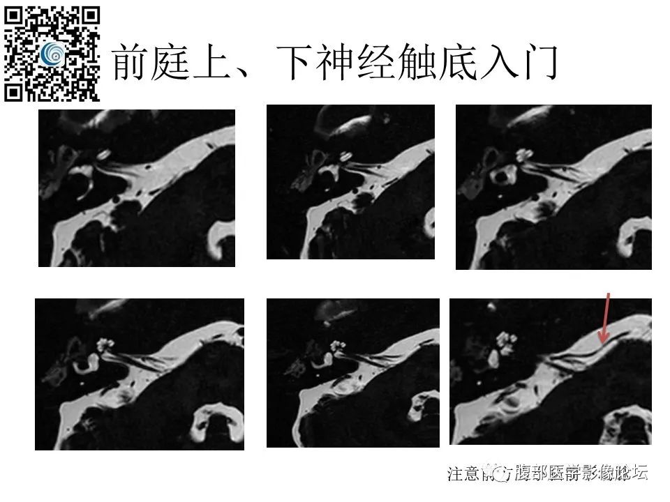影像PPT - 【PPT】颅骨颅底系列之触底四神共一门-17
