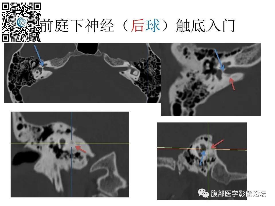 影像PPT - 【PPT】颅骨颅底系列之触底四神共一门-16