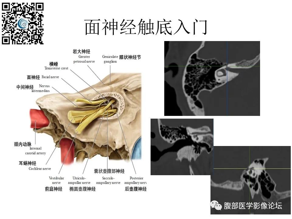 影像PPT - 【PPT】颅骨颅底系列之触底四神共一门-18