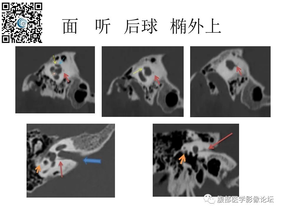 影像PPT - 【PPT】颅骨颅底系列之触底四神共一门-22