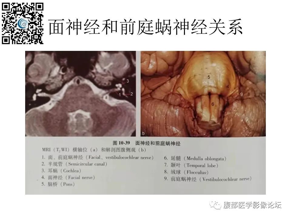 影像PPT - 【PPT】颅骨颅底系列之触底四神共一门-23