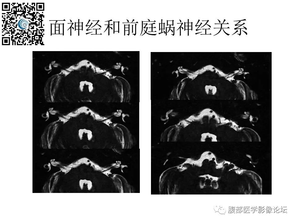 影像PPT - 【PPT】颅骨颅底系列之触底四神共一门-24
