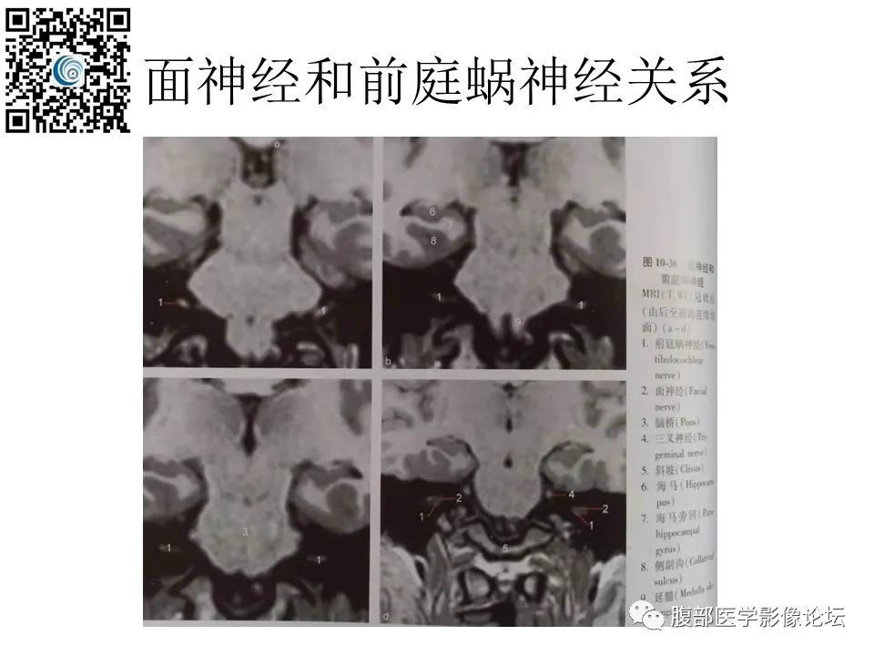 影像PPT - 【PPT】颅骨颅底系列之触底四神共一门-25