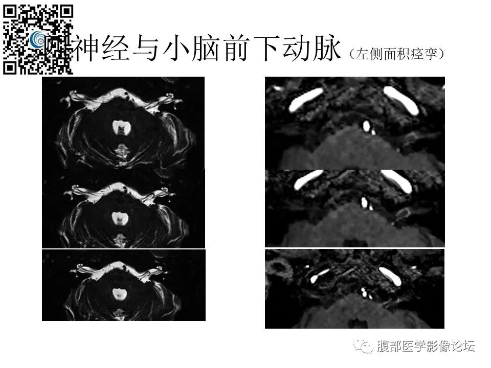影像PPT - 【PPT】颅骨颅底系列之触底四神共一门-27