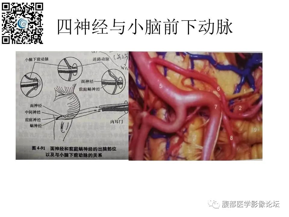 影像PPT - 【PPT】颅骨颅底系列之触底四神共一门-26