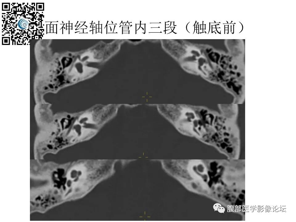 影像PPT - 【PPT】颅骨颅底系列之触底四神共一门-28