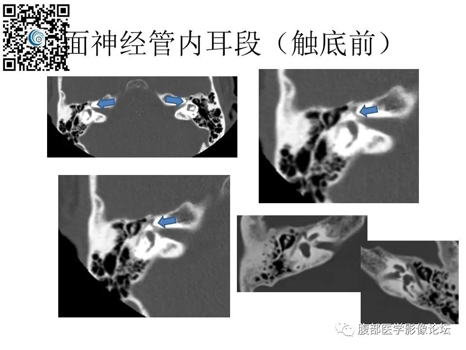 影像PPT - 【PPT】颅骨颅底系列之触底四神共一门-29