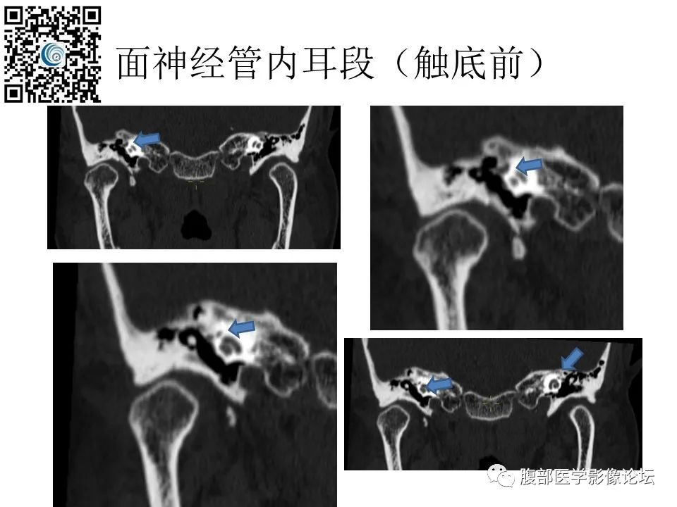 影像PPT - 【PPT】颅骨颅底系列之触底四神共一门-30
