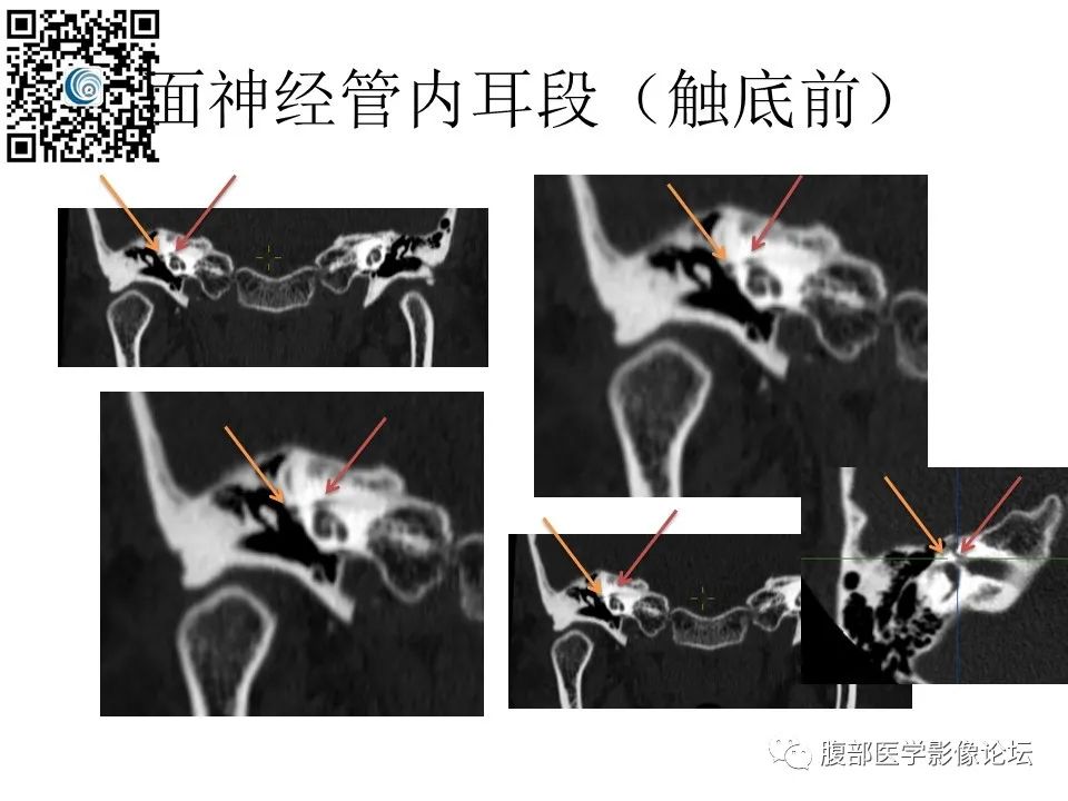影像PPT - 【PPT】颅骨颅底系列之触底四神共一门-31