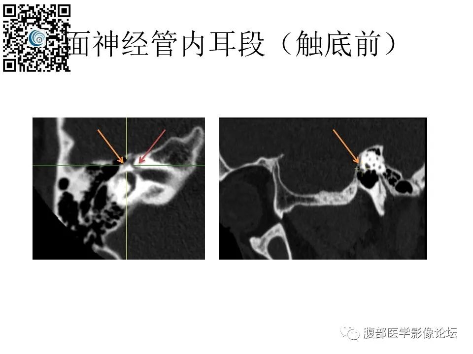 影像PPT - 【PPT】颅骨颅底系列之触底四神共一门-33